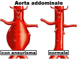 Aneurisma dell'aorta addominale