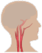 le arterie carotidi
