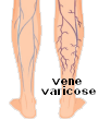 Vene varicose
